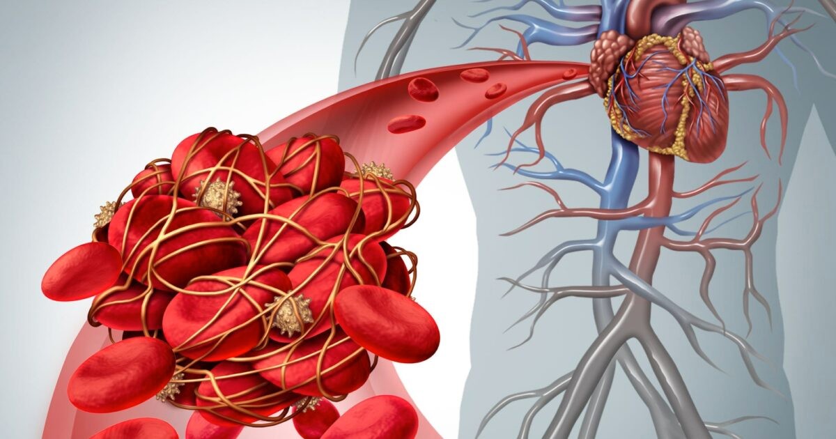 Atherosclerosis